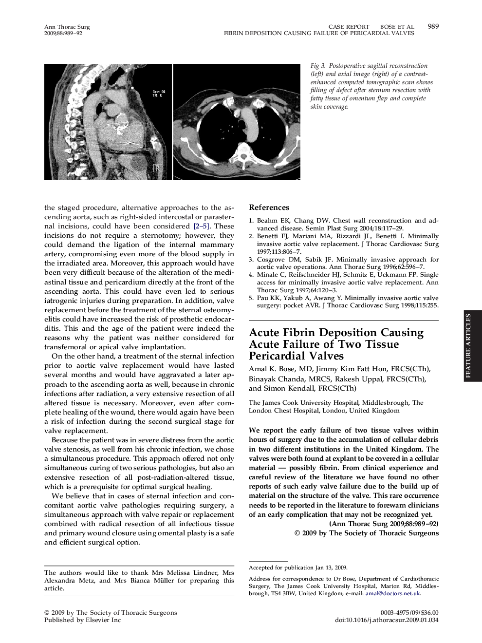 Acute Fibrin Deposition Causing Acute Failure of Two Tissue Pericardial Valves