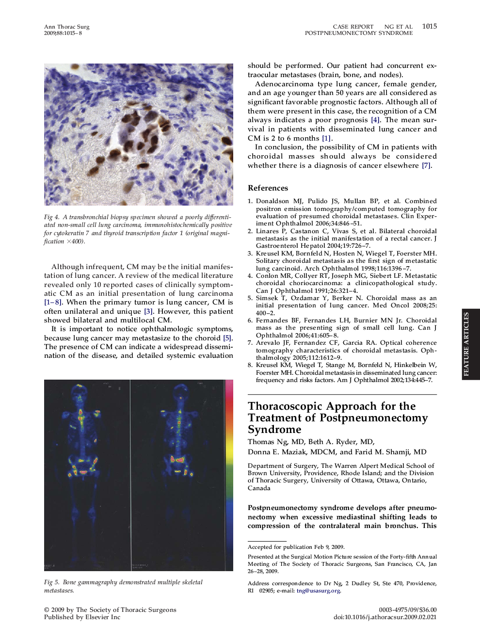 Thoracoscopic Approach for the Treatment of Postpneumonectomy Syndrome