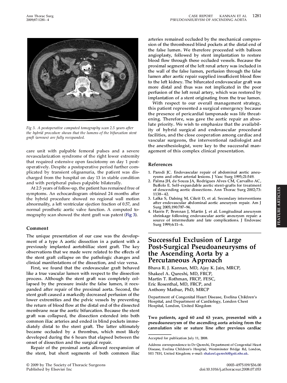 Successful Exclusion of Large Post-Surgical Pseudoaneurysms of the Ascending Aorta by a Percutaneous Approach