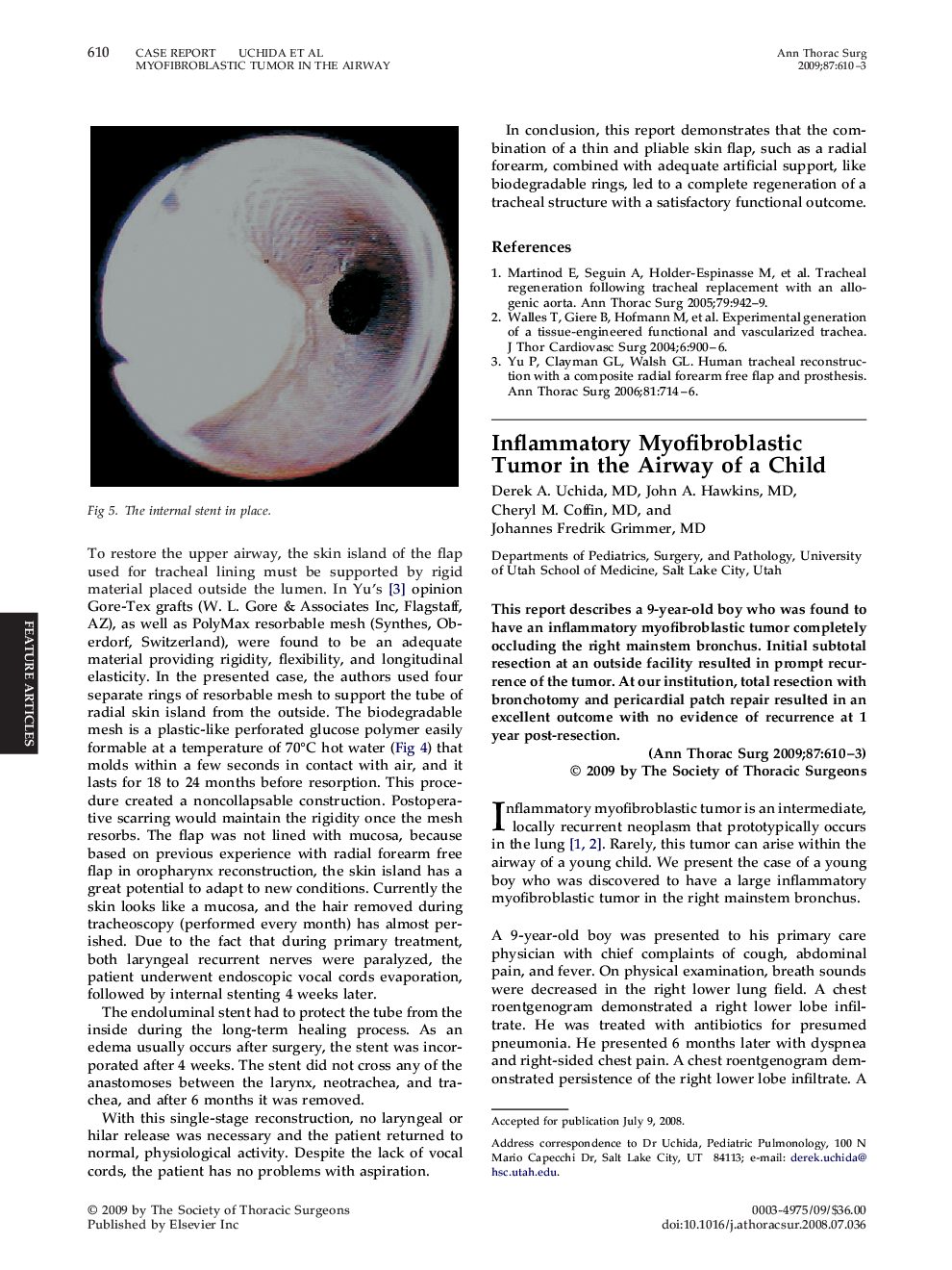 Inflammatory Myofibroblastic Tumor in the Airway of a Child