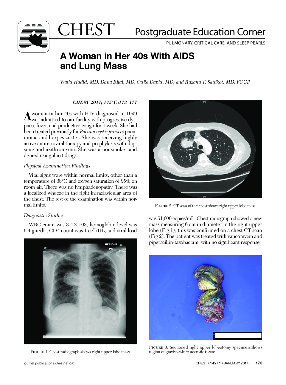 A Woman in Her 40s With AIDS and Lung Mass