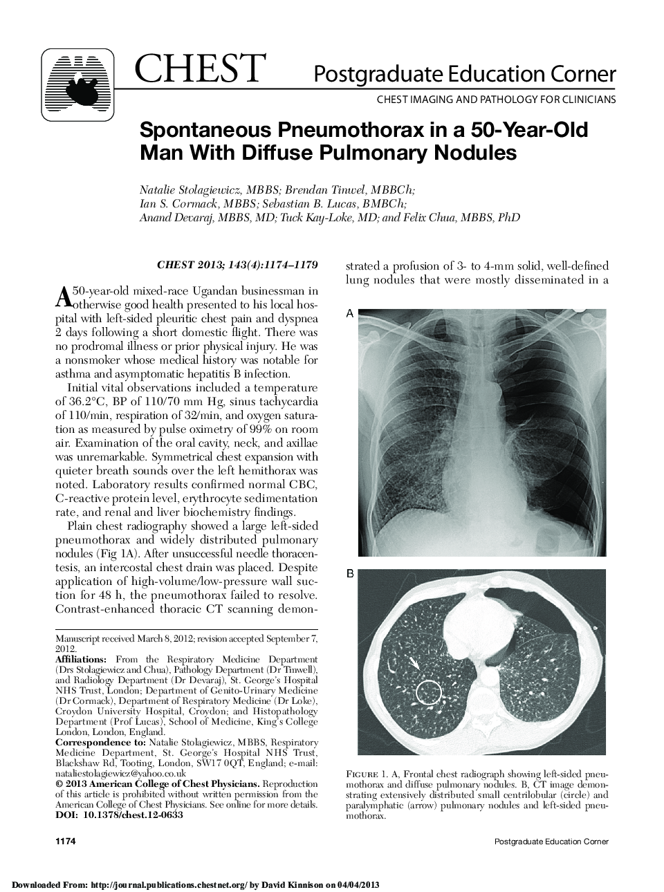 Spontaneous Pneumothorax in a 50-Year-Old Man With Diffuse Pulmonary Nodules