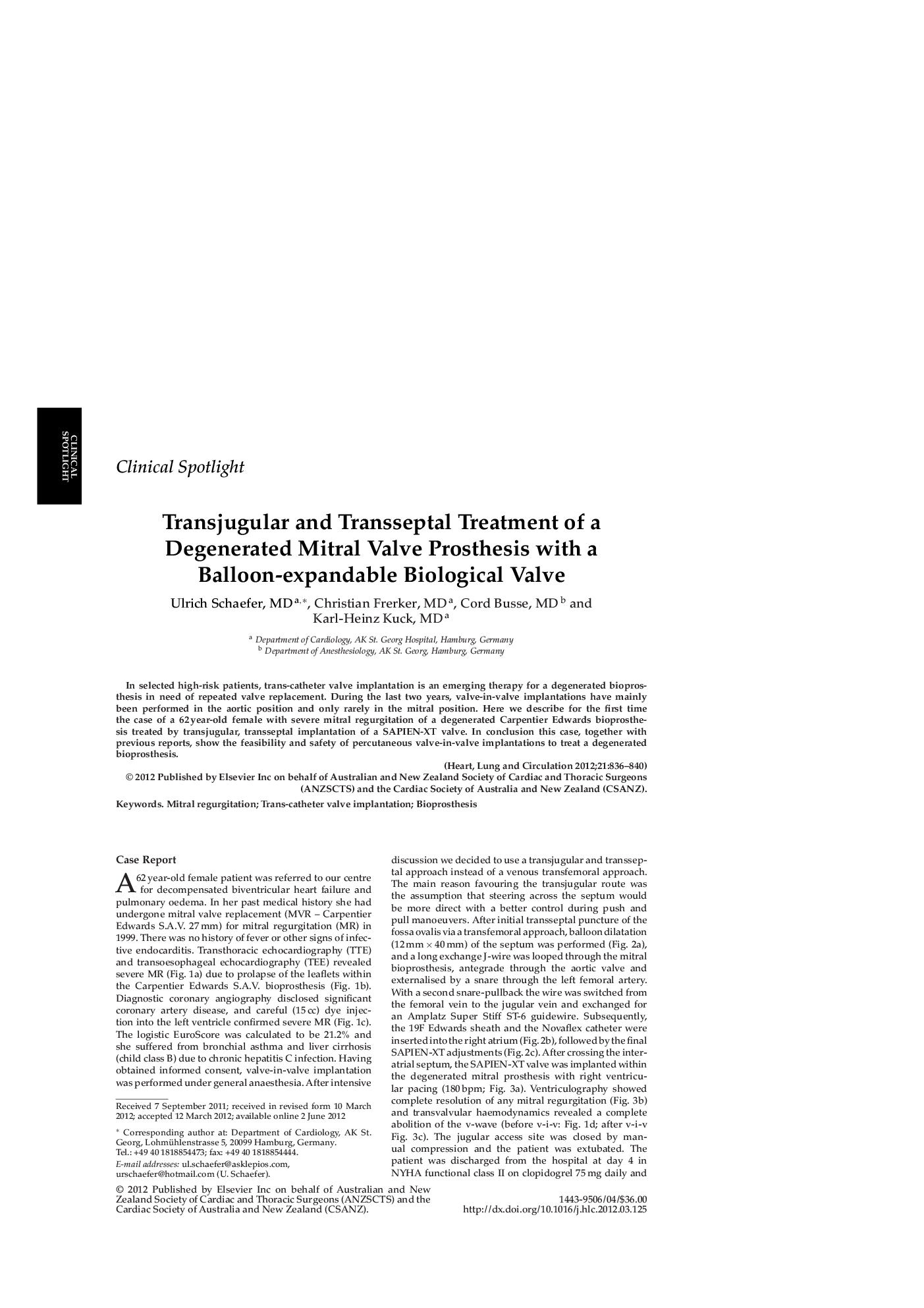 Transjugular and Transseptal Treatment of a Degenerated Mitral Valve Prosthesis with a Balloon-expandable Biological Valve