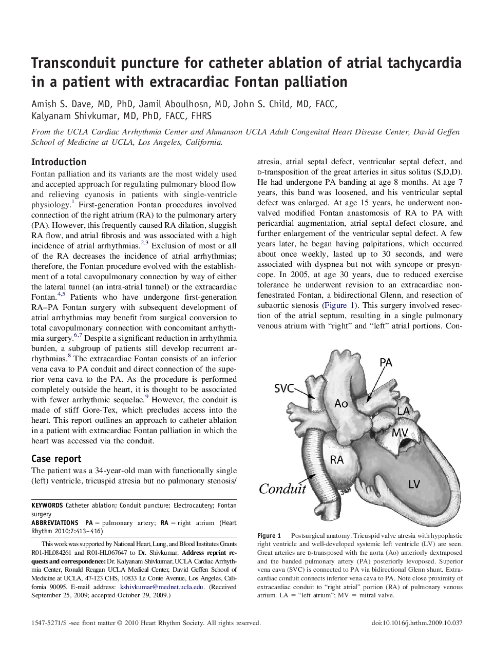 Transconduit puncture for catheter ablation of atrial tachycardia in a patient with extracardiac Fontan palliation