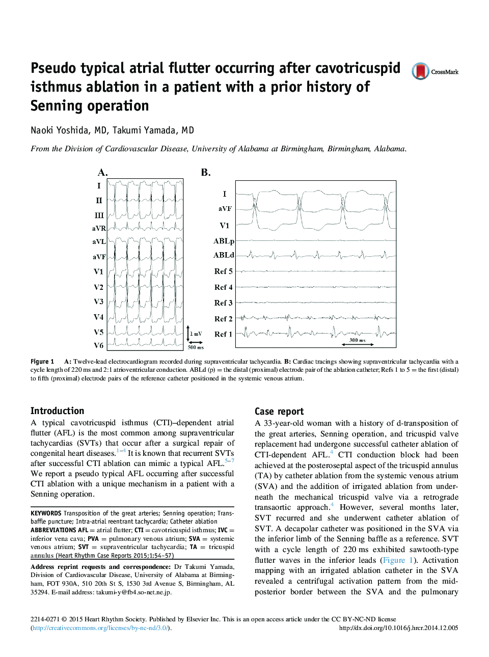 Pseudo typical atrial flutter occurring after cavotricuspid isthmus ablation in a patient with a prior history of Senning operation