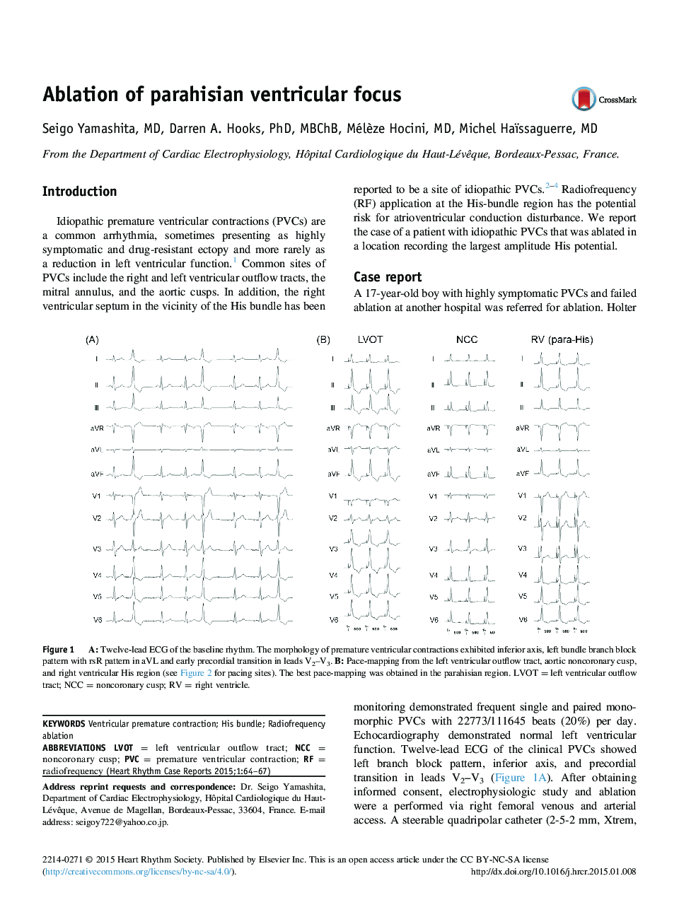 Ablation of parahisian ventricular focus