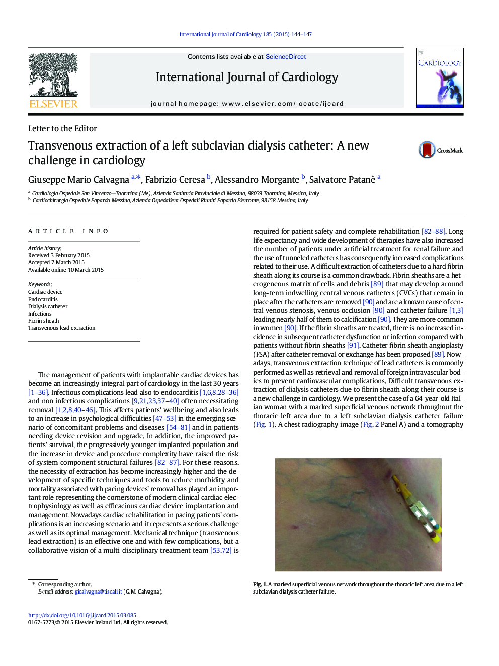 Transvenous extraction of a left subclavian dialysis catheter: A new challenge in cardiology