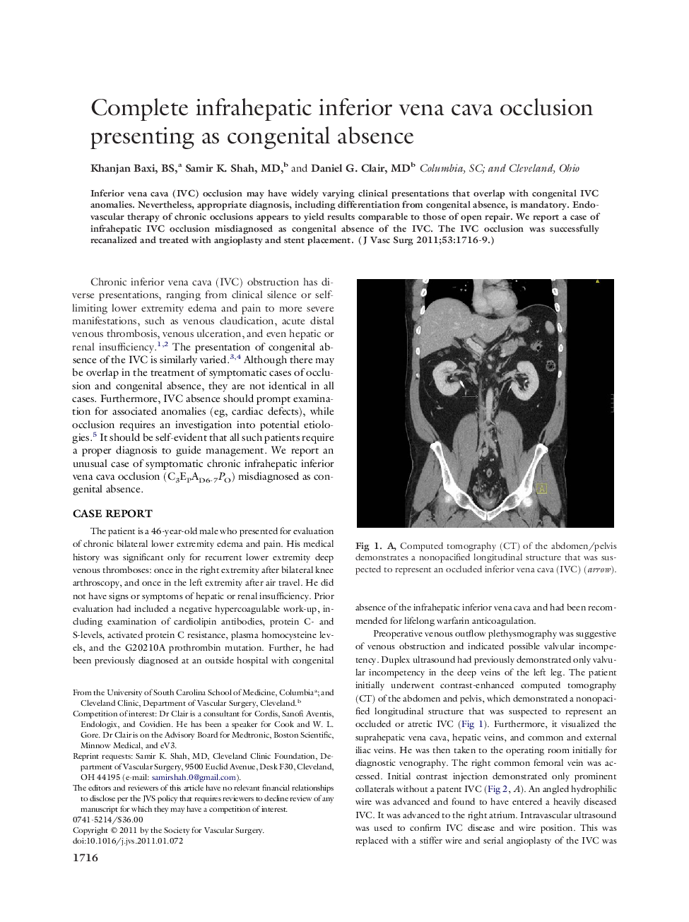 Complete infrahepatic inferior vena cava occlusion presenting as congenital absence 