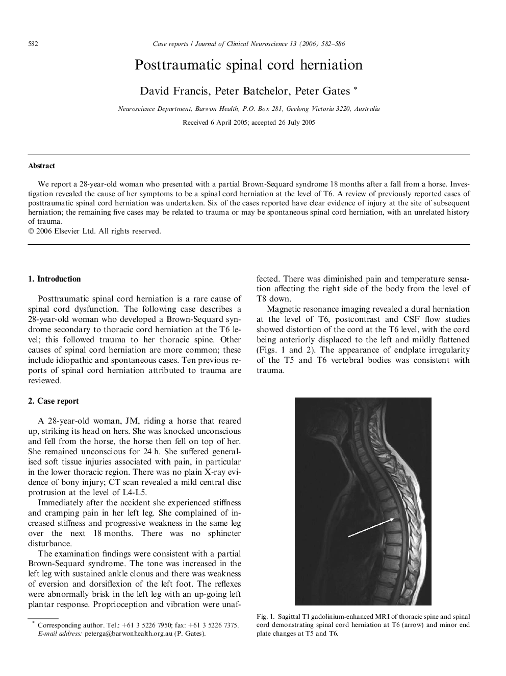 Posttraumatic spinal cord herniation