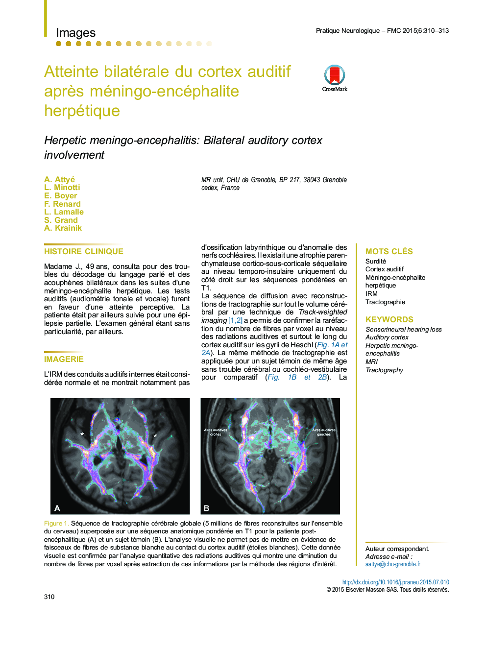 Atteinte bilatérale du cortex auditif aprÃ¨s méningo-encéphalite herpétique