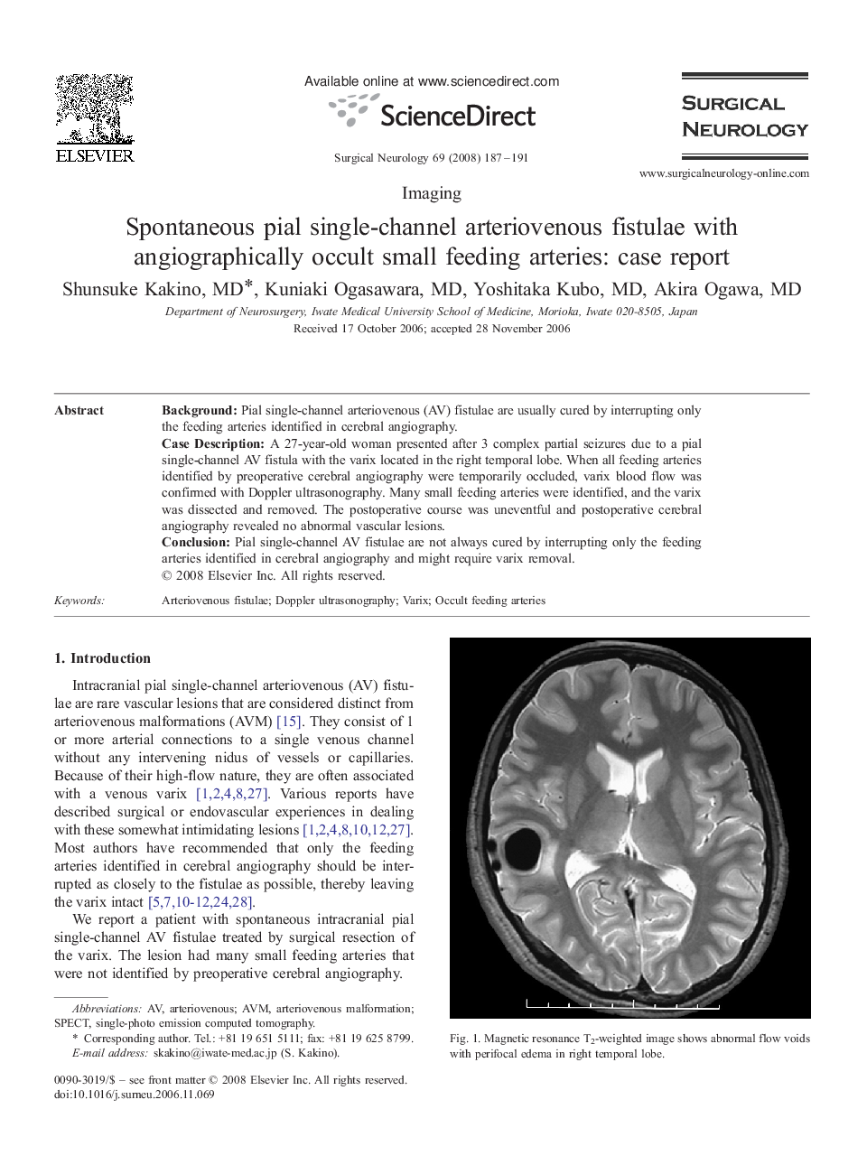 Spontaneous pial single-channel arteriovenous fistulae with angiographically occult small feeding arteries: case report