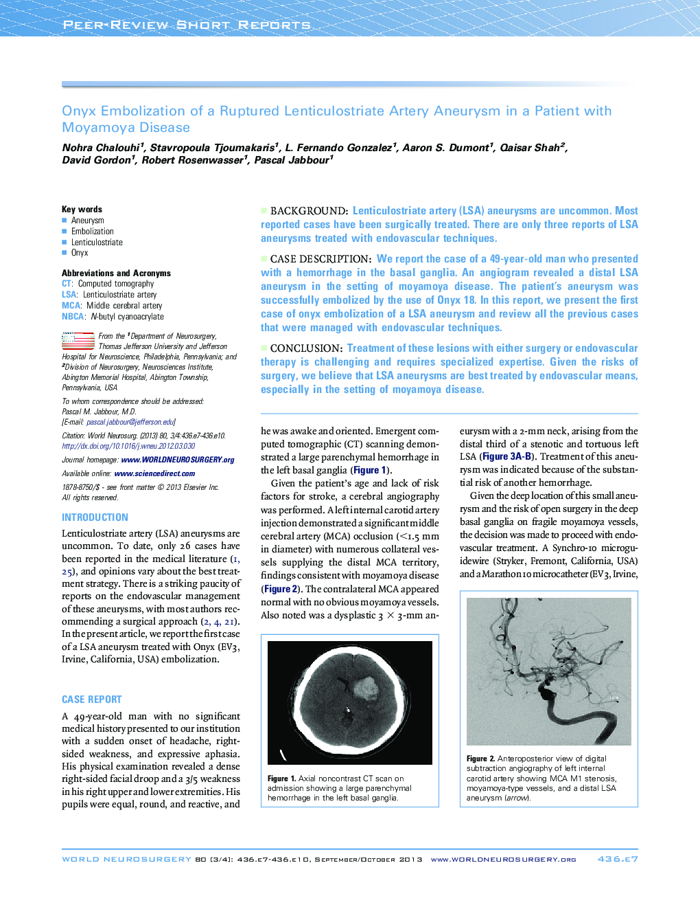 Onyx Embolization of a Ruptured Lenticulostriate Artery Aneurysm in a Patient with Moyamoya Disease