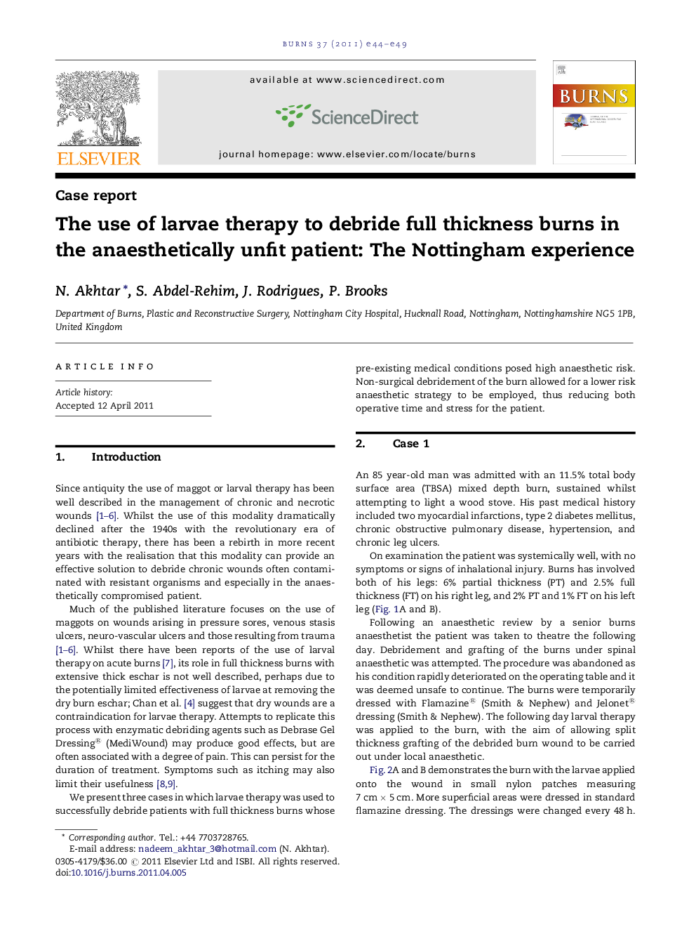 The use of larvae therapy to debride full thickness burns in the anaesthetically unfit patient: The Nottingham experience