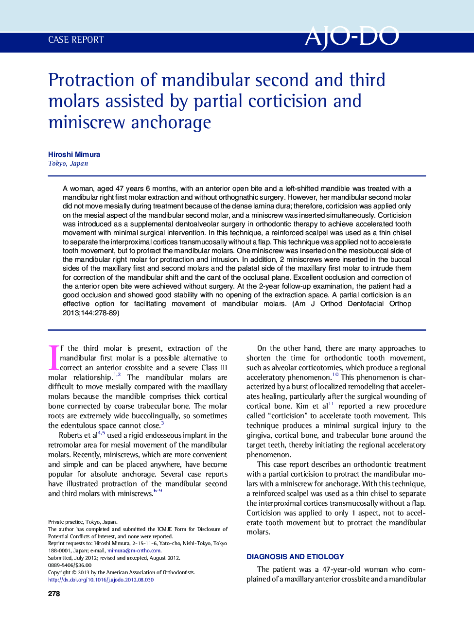 Protraction of mandibular second and third molars assisted by partial corticision and miniscrew anchorage 