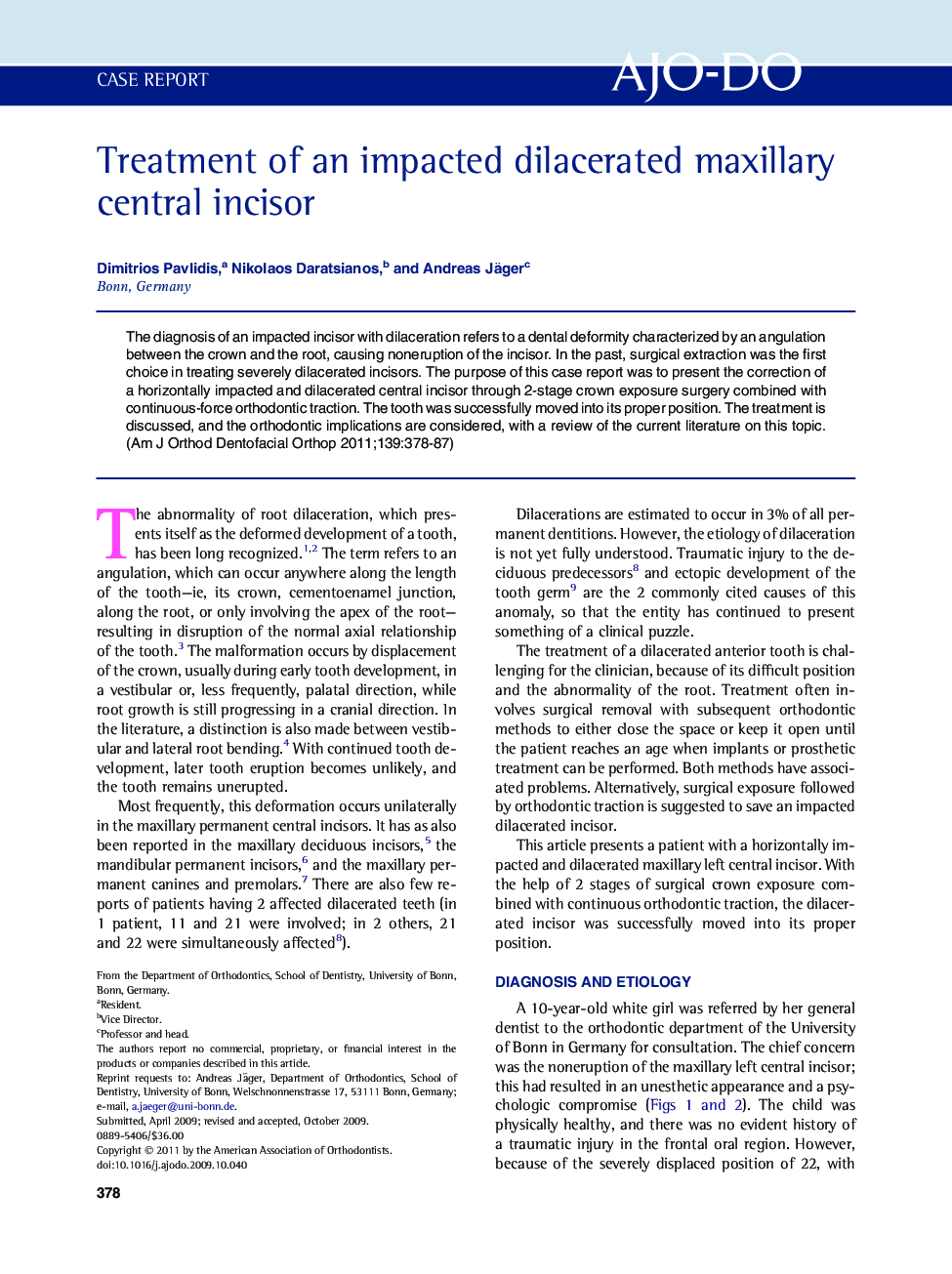 Treatment of an impacted dilacerated maxillary central incisor 