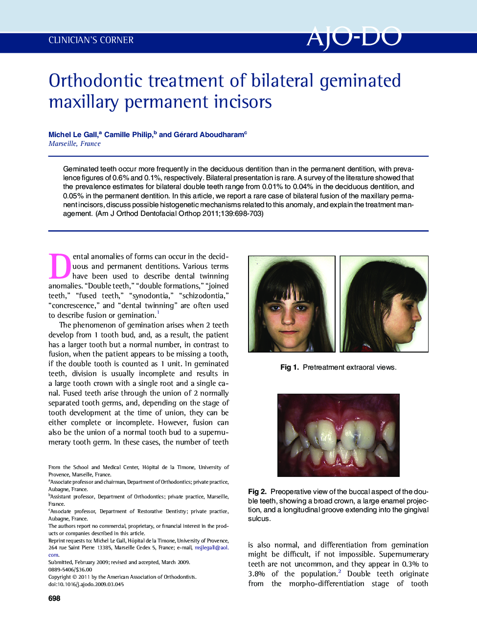 Orthodontic treatment of bilateral geminated maxillary permanent incisors 