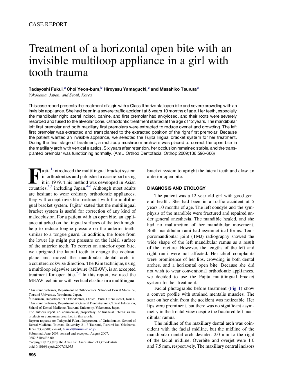 Treatment of a horizontal open bite with an invisible multiloop appliance in a girl with tooth trauma 