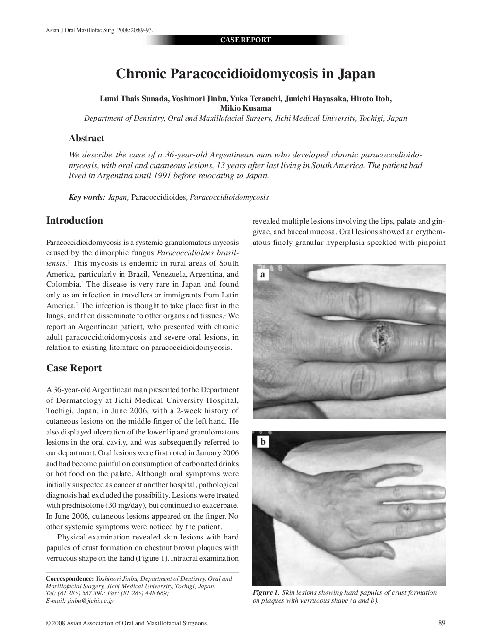 Chronic Paracoccidioidomycosis in Japan