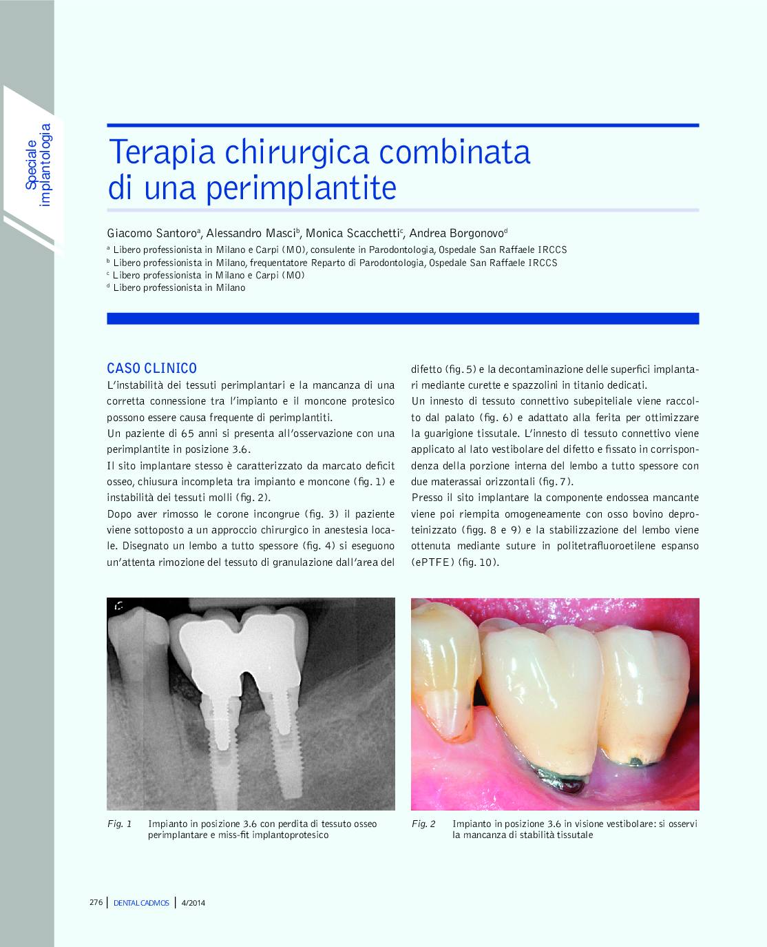 عکس صفحه اول مقاله: Terapia chirurgica combinata di una perimplantite Terapia chirurgica combinata di una perimplantite