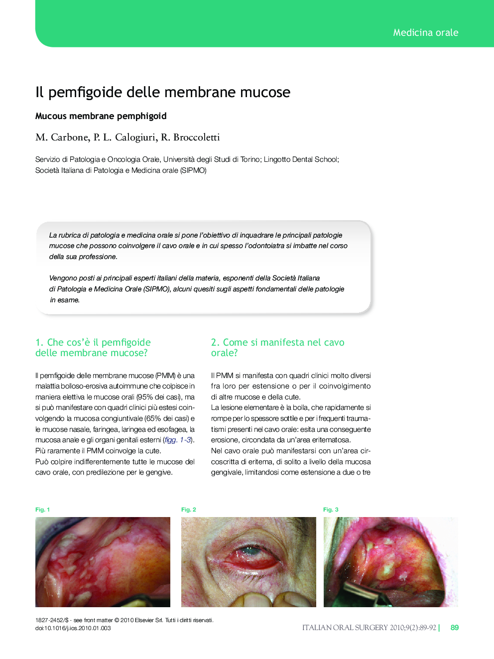 عکس صفحه اول مقاله: Il pemfigoide delle membrane mucose Il pemfigoide delle membrane mucose