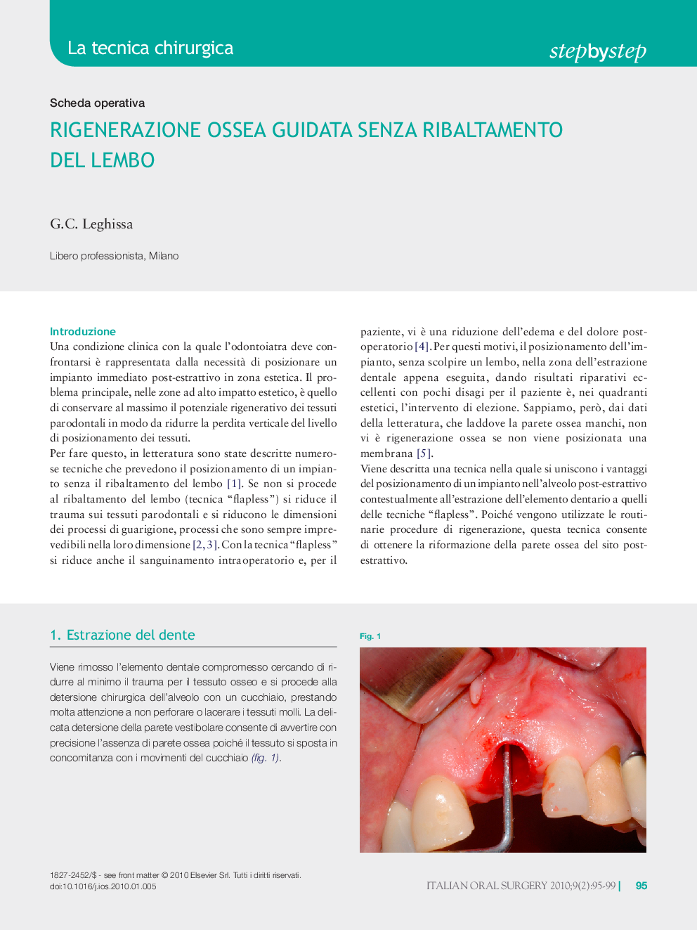 عکس صفحه اول مقاله: Rigenerazione ossea guidata senza ribaltamento del lembo Rigenerazione ossea guidata senza ribaltamento del lembo