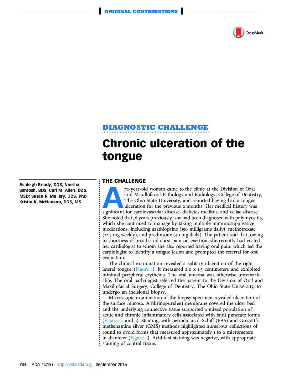 Chronic ulceration of the tongue