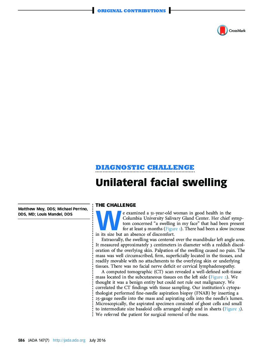 Unilateral facial swelling