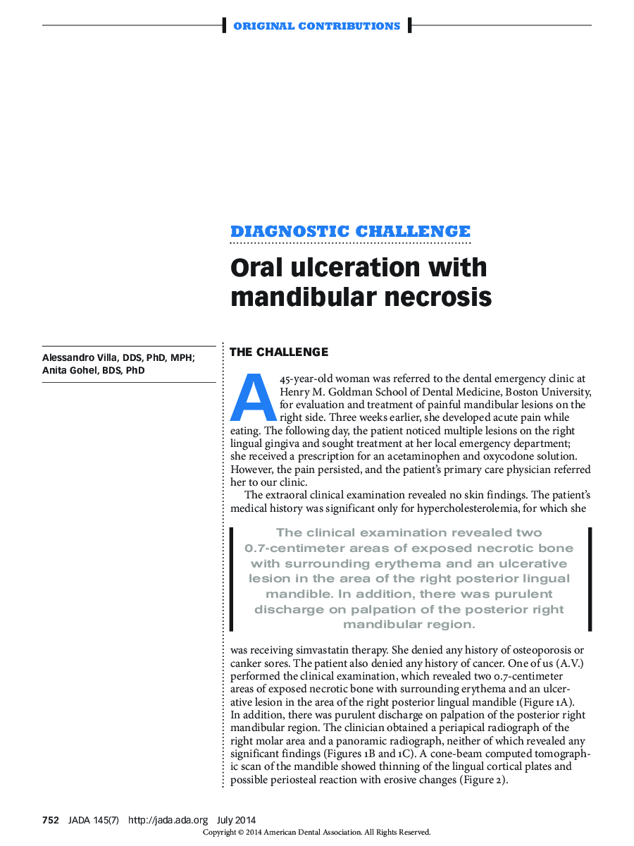 Oral ulceration with mandibular necrosis