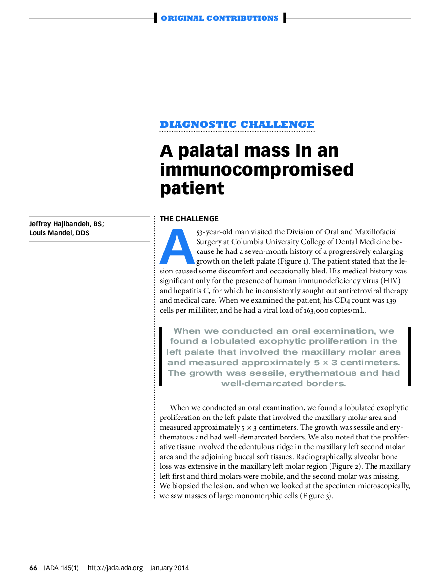 A palatal mass in an immunocompromised patient