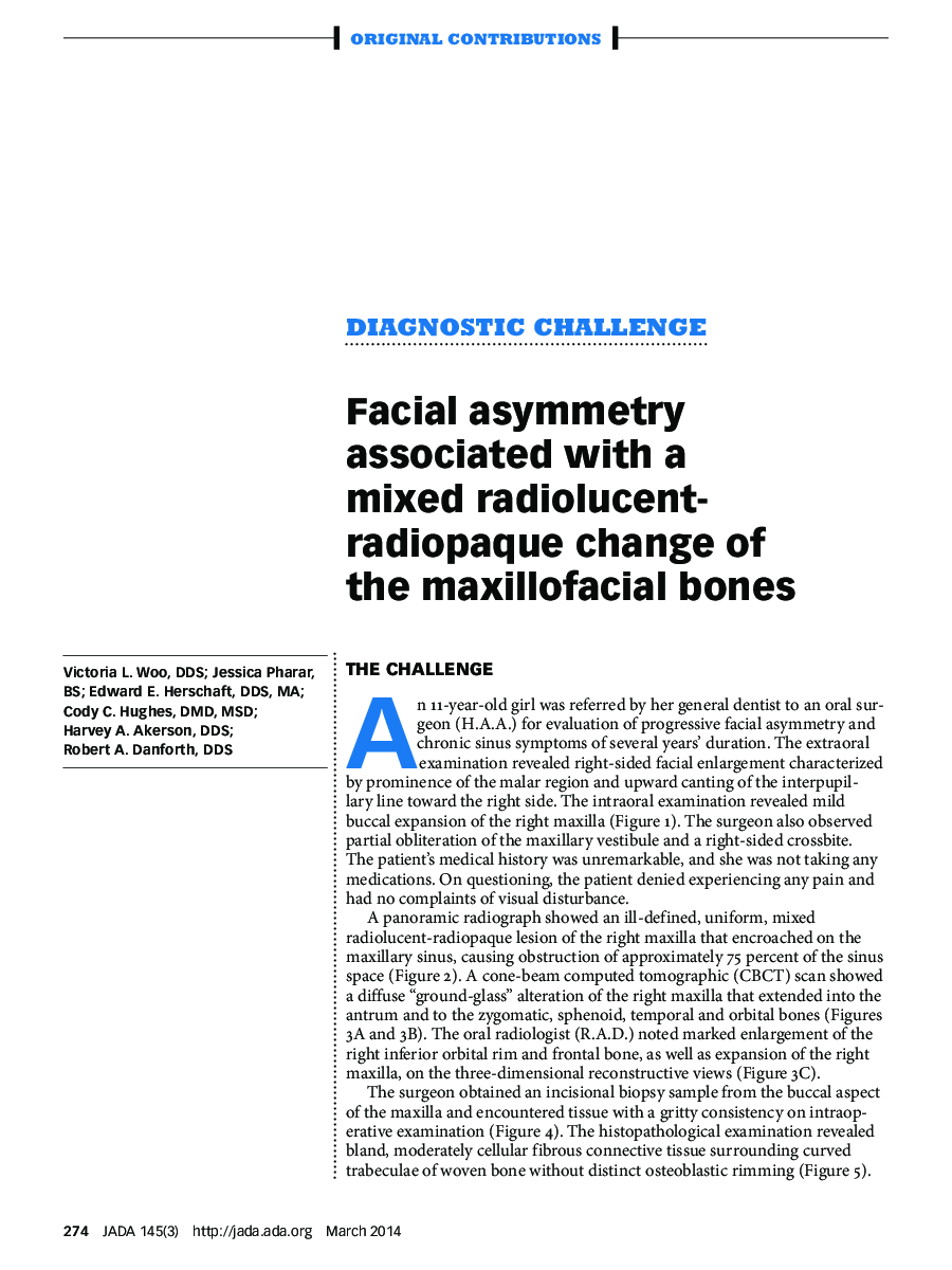 Facial asymmetry associated with a mixed radiolucent-radiopaque change of the maxillofacial bones