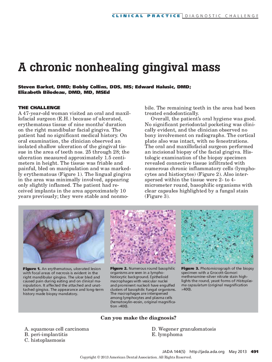 A chronic nonhealing gingival mass