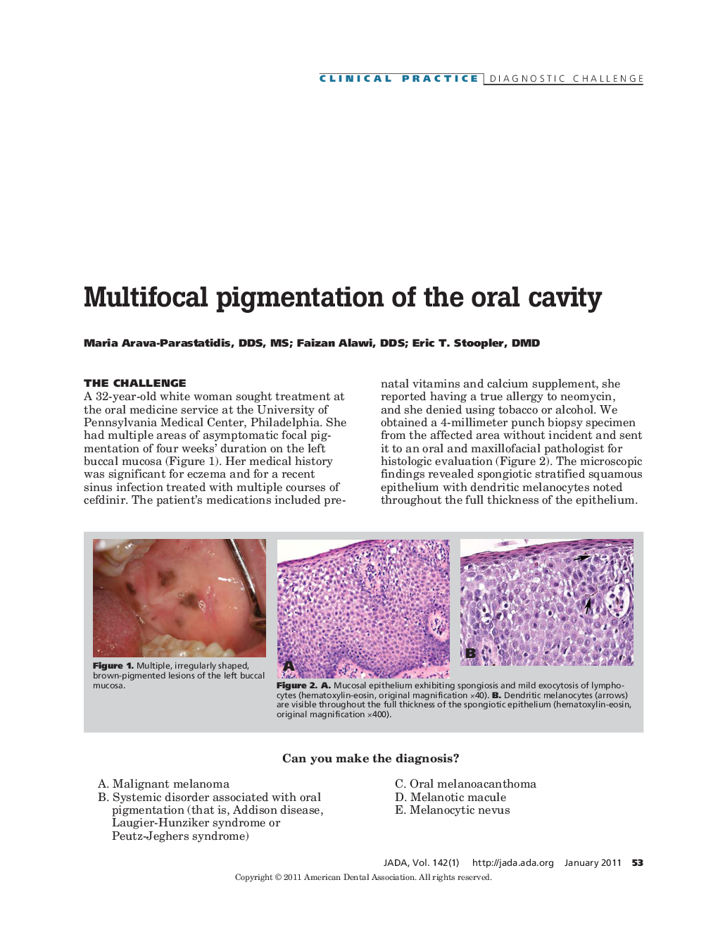 Multifocal Pigmentation of the Oral Cavity