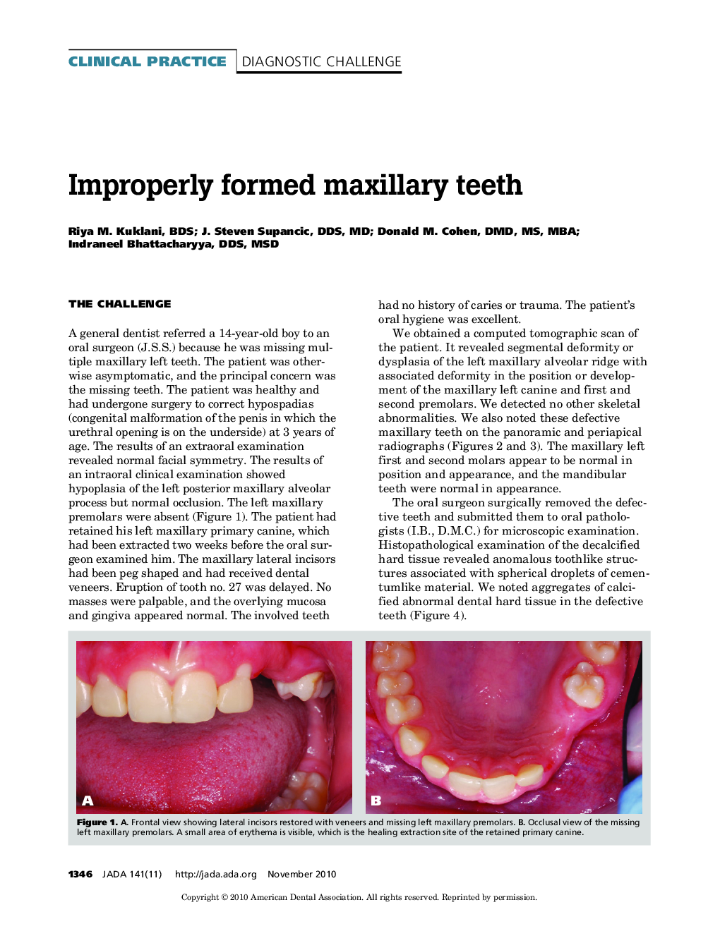 Improperly Formed Maxillary Teeth