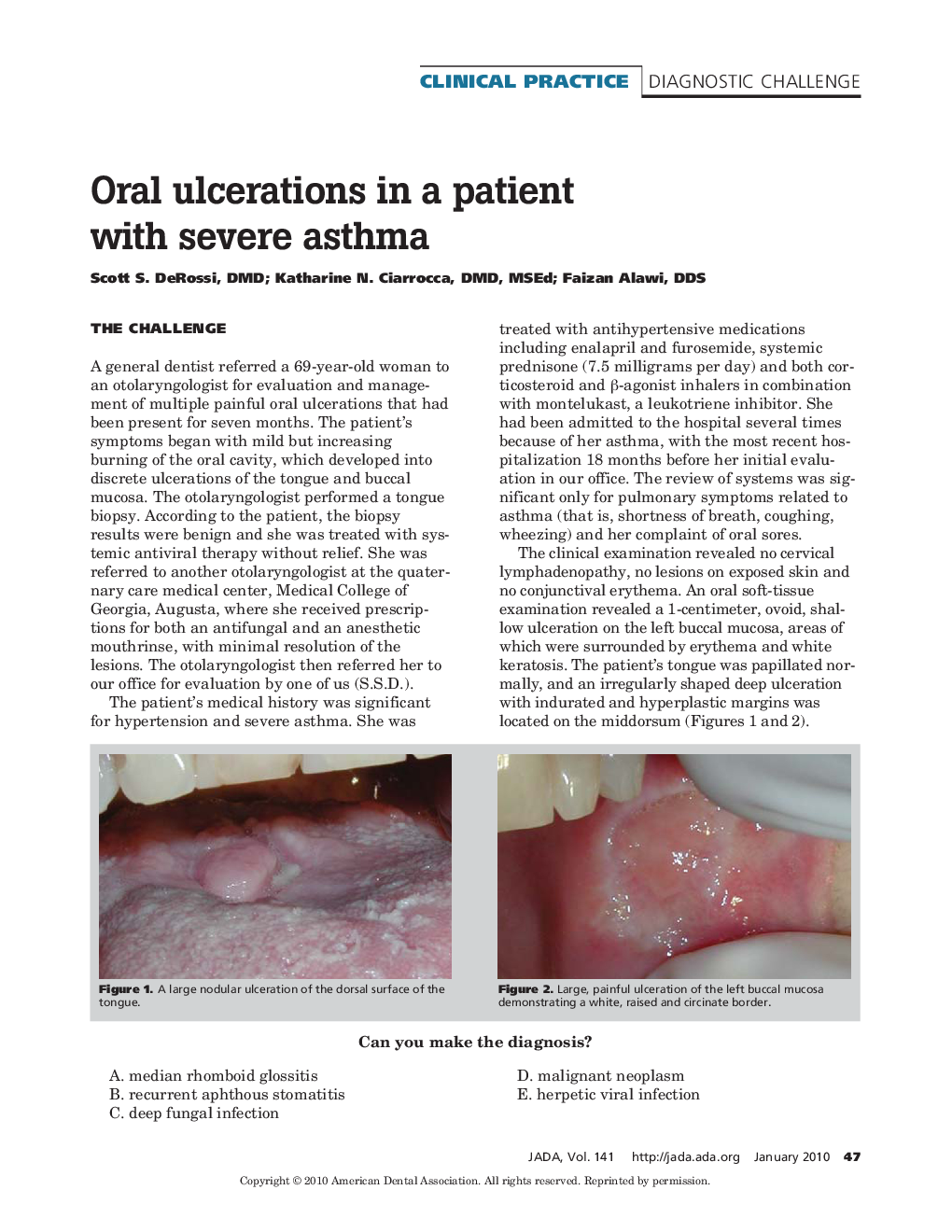 Oral ulcerations in a patient with severe asthma