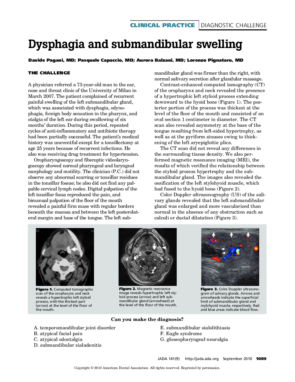 Dysphagia and Submandibular Swelling