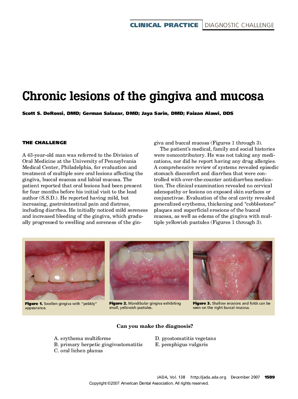 Chronic Lesions of the Gingiva and Mucosa