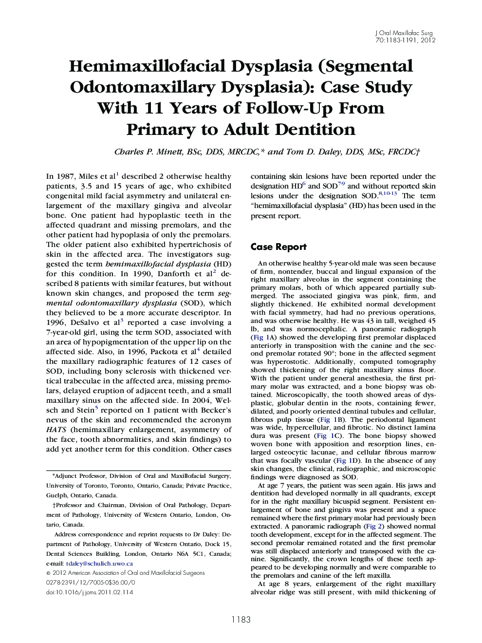 Hemimaxillofacial Dysplasia (Segmental Odontomaxillary Dysplasia): Case Study With 11 Years of Follow-Up From Primary to Adult Dentition