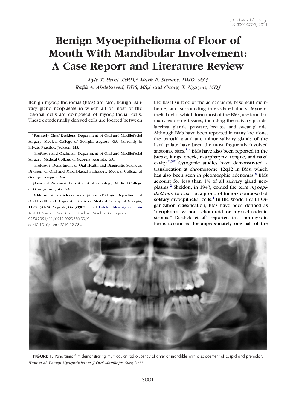 Benign Myoepithelioma of Floor of Mouth With Mandibular Involvement: A Case Report and Literature Review