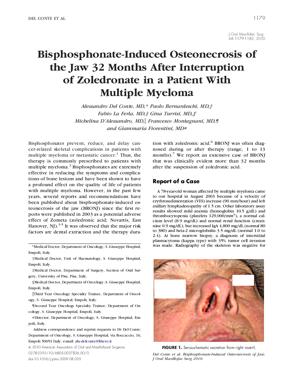 عکس صفحه اول مقاله: Bisphosphonate-Induced Osteonecrosis of the Jaw 32 Months After Interruption of Zoledronate in a Patient With Multiple Myeloma Bisphosphonate-Induced Osteonecrosis of the Jaw 32 Months After Interruption of Zoledronate in a Patient With Multiple Myeloma