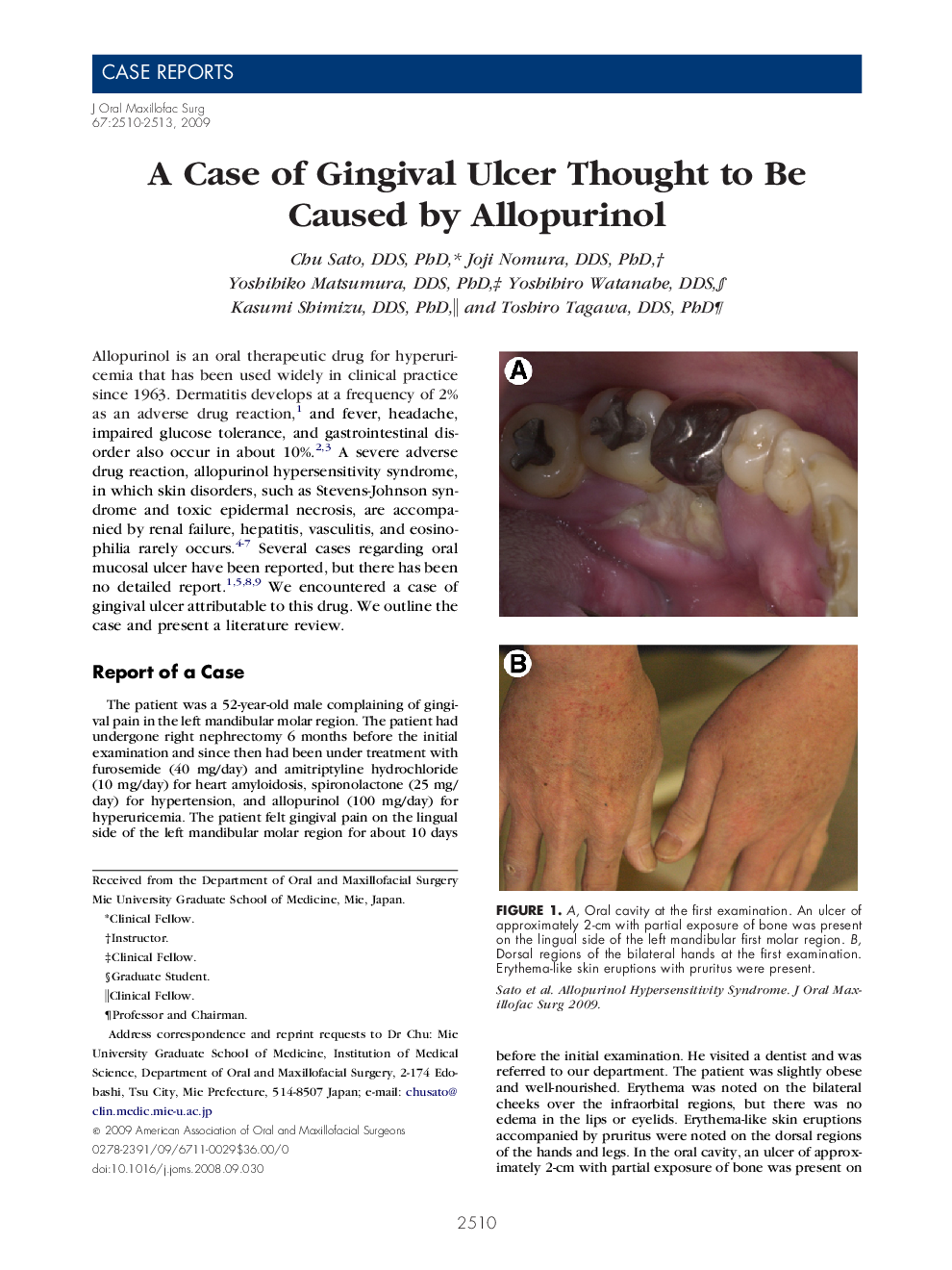 A Case of Gingival Ulcer Thought to Be Caused by Allopurinol