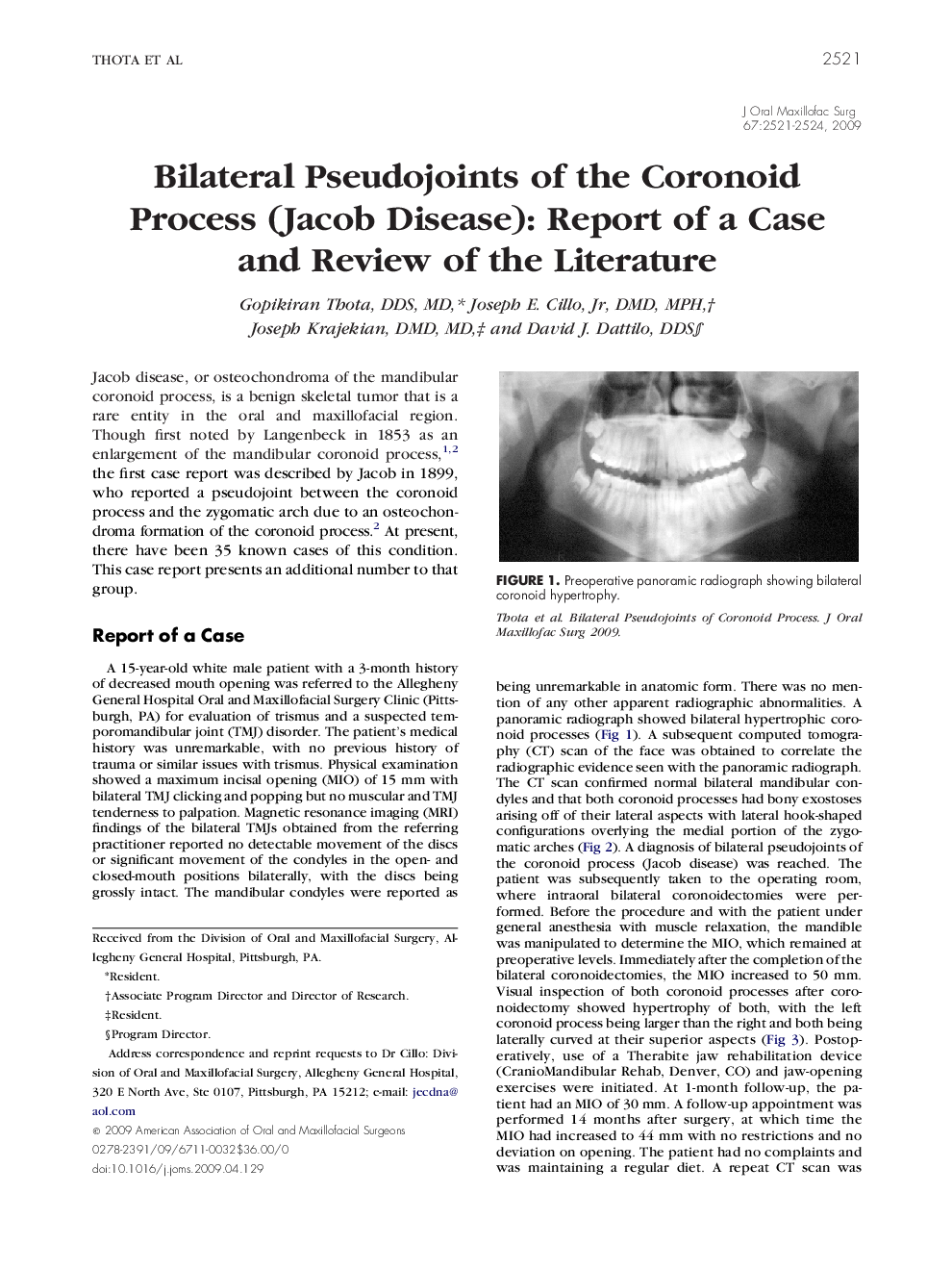 Bilateral Pseudojoints of the Coronoid Process (Jacob Disease): Report of a Case and Review of the Literature
