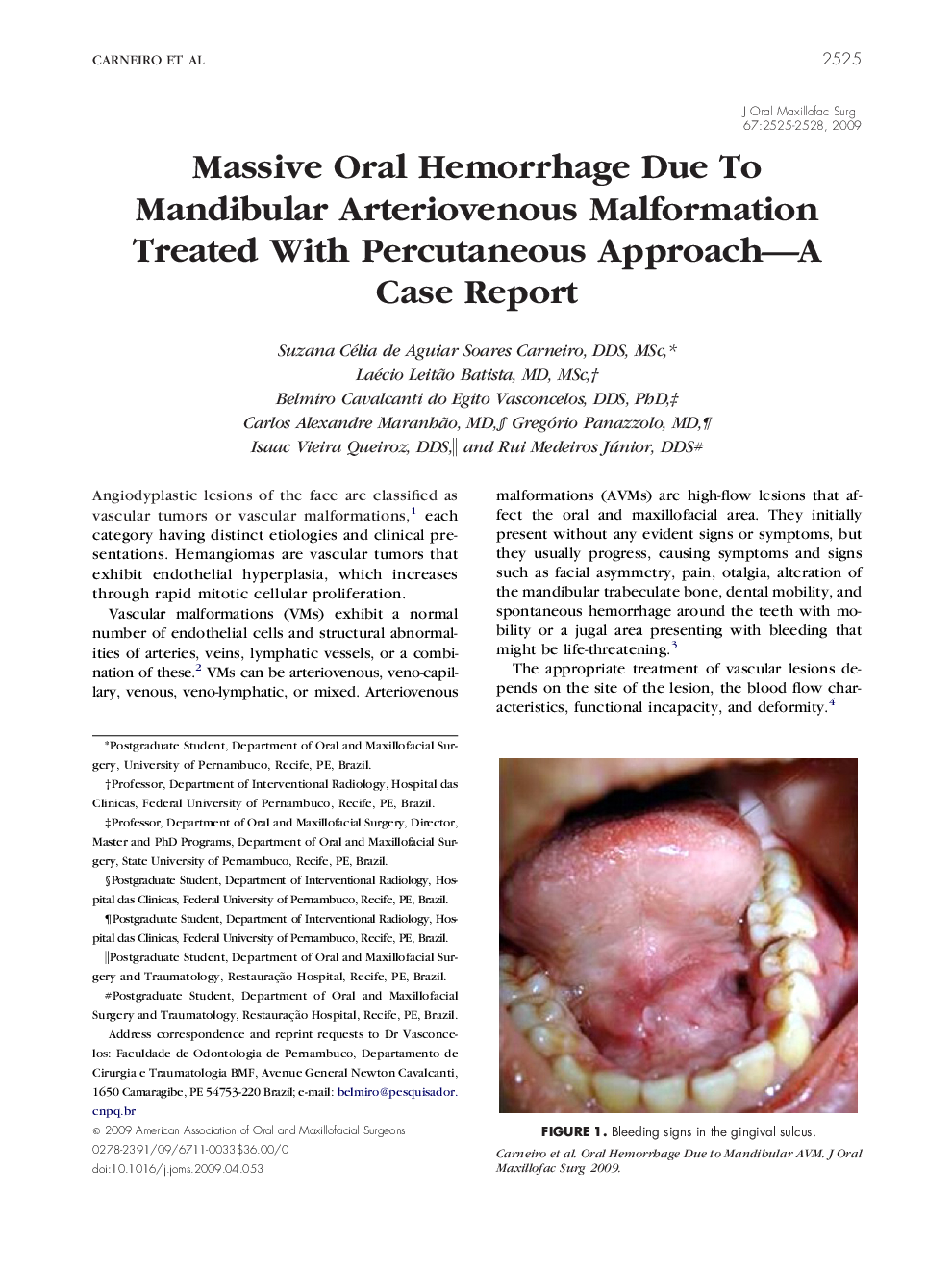 Massive Oral Hemorrhage Due To Mandibular Arteriovenous Malformation Treated With Percutaneous Approach-A Case Report