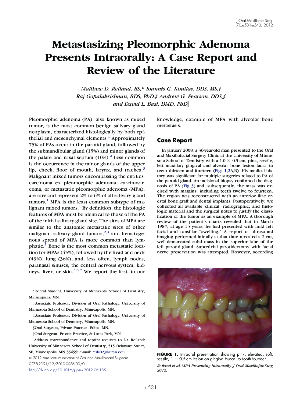 Metastasizing Pleomorphic Adenoma Presents Intraorally: A Case Report and Review of the Literature