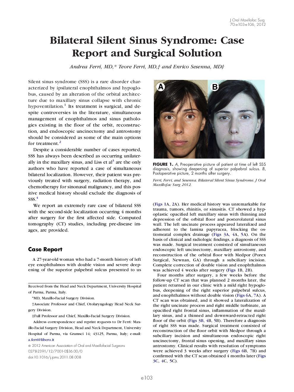 Bilateral Silent Sinus Syndrome: Case Report and Surgical Solution