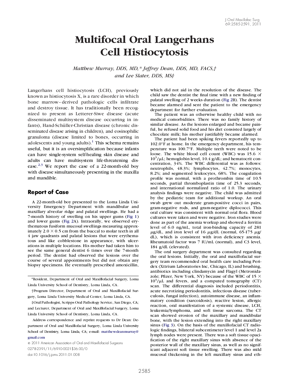 Multifocal Oral Langerhans Cell Histiocytosis