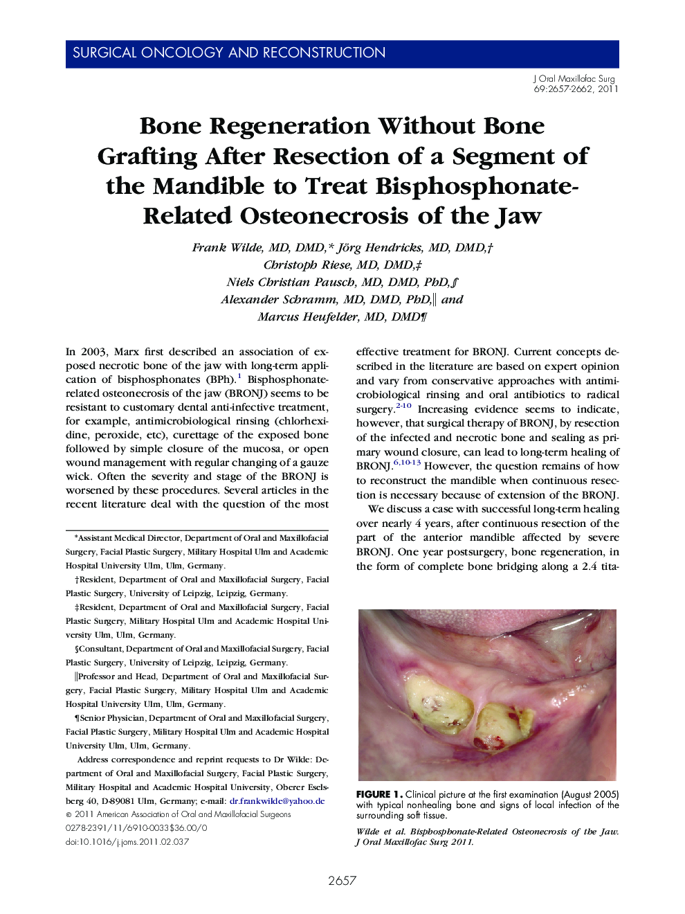 Bone Regeneration Without Bone Grafting After Resection of a Segment of the Mandible to Treat Bisphosphonate-Related Osteonecrosis of the Jaw