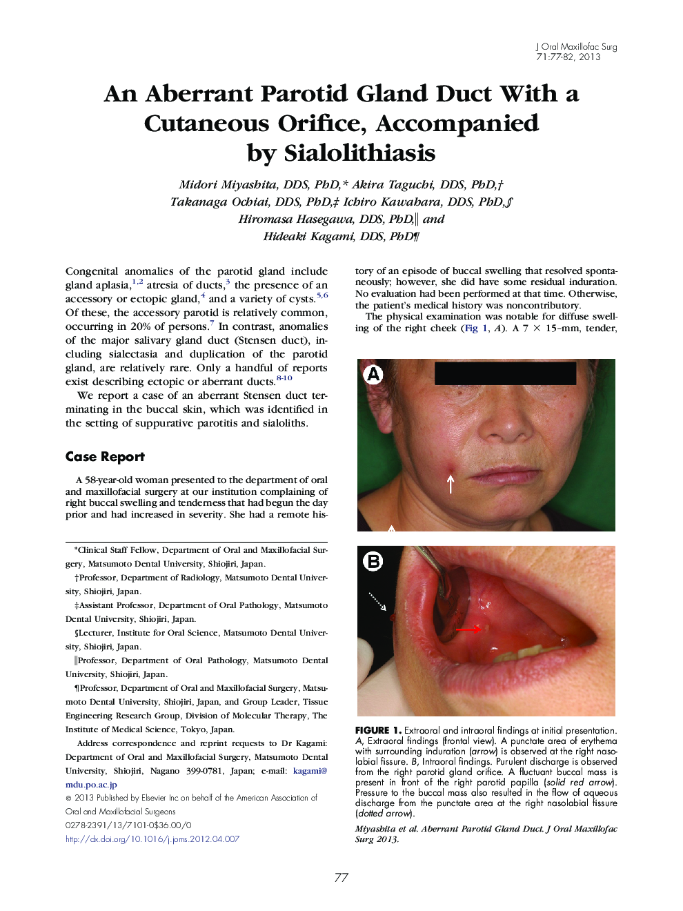 An Aberrant Parotid Gland Duct With a Cutaneous Orifice, Accompanied by Sialolithiasis