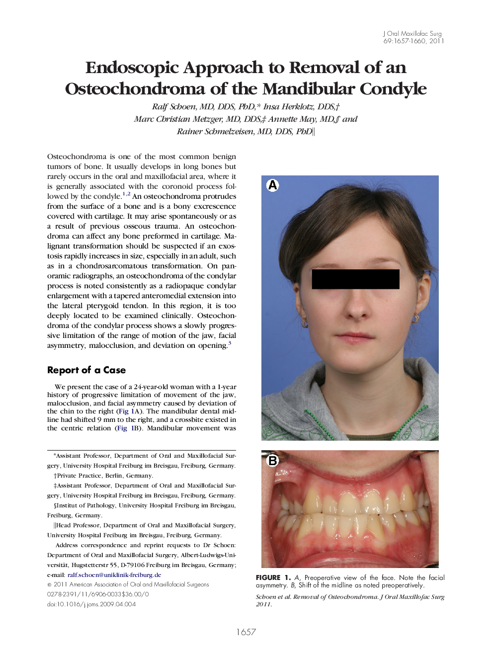 Endoscopic Approach to Removal of an Osteochondroma of the Mandibular Condyle