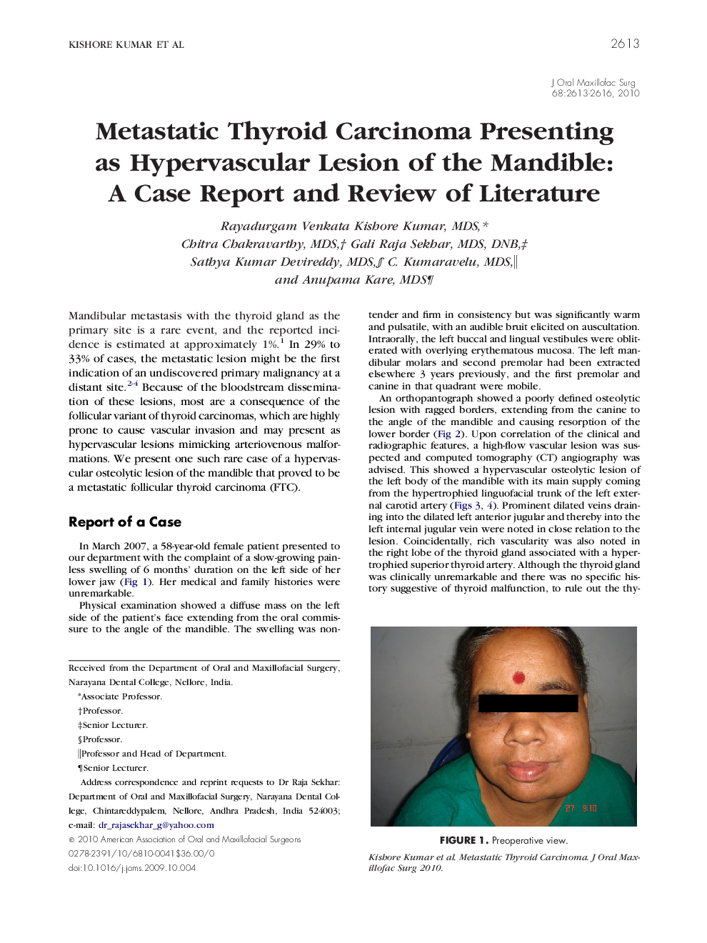 Metastatic Thyroid Carcinoma Presenting as Hypervascular Lesion of the Mandible: A Case Report and Review of Literature