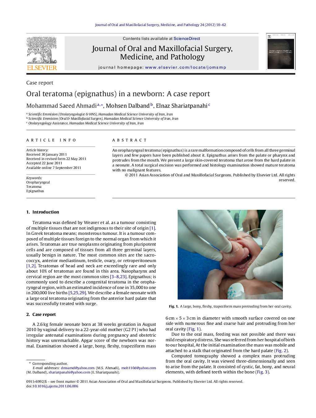 Oral teratoma (epignathus) in a newborn: A case report